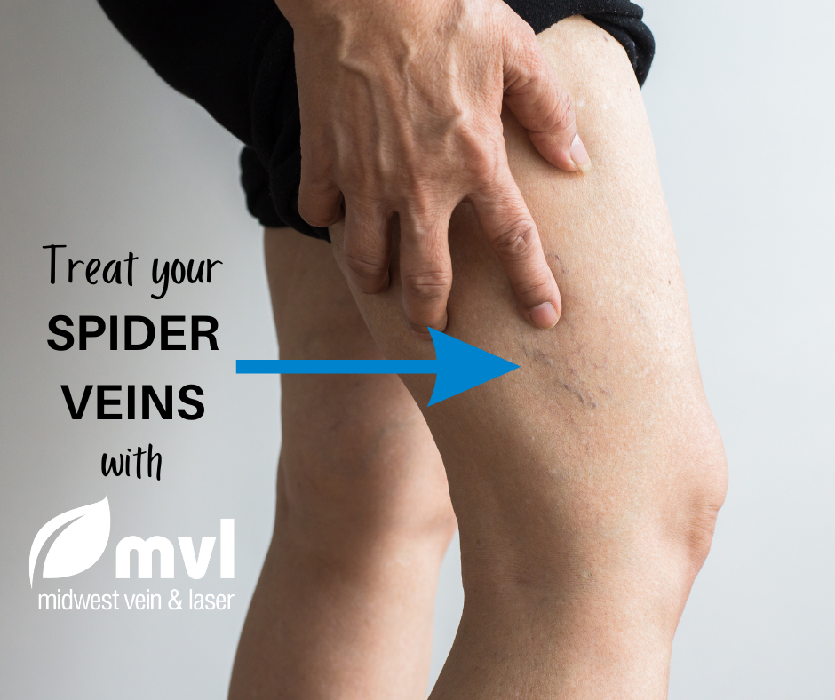 Midwest Vein and Laser | 900 S Dixie Dr Suite 50, Vandalia, OH 45377 | Phone: (937) 281-0200