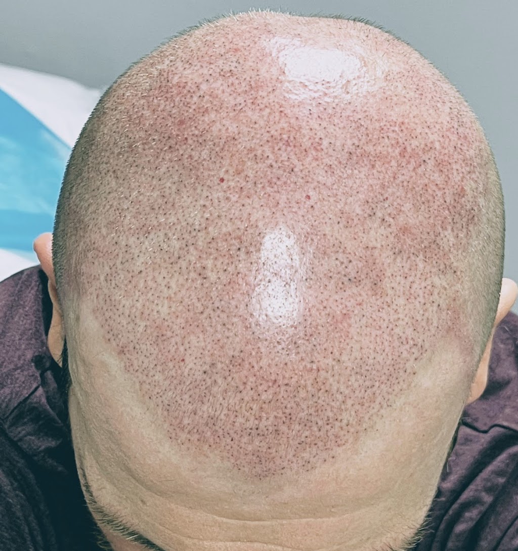 New You Ink Scalp Micropigmentation and Aesthetics | 1348 Sharon Copley Rd, Wadsworth, OH 44281 | Phone: (216) 626-5311