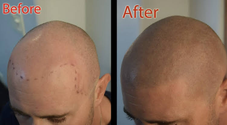 New You Ink Scalp Micropigmentation and Aesthetics | 1348 Sharon Copley Rd, Wadsworth, OH 44281 | Phone: (216) 626-5311